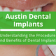 Illustration for article titled Austin Dental Implants – Understanding the Procedure and Benefits of Dental Implantsem/em
